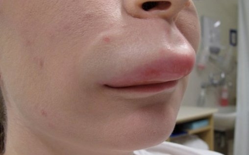 SESA se suma a la conmemoración del Día Mundial del Angioedema Hereditario